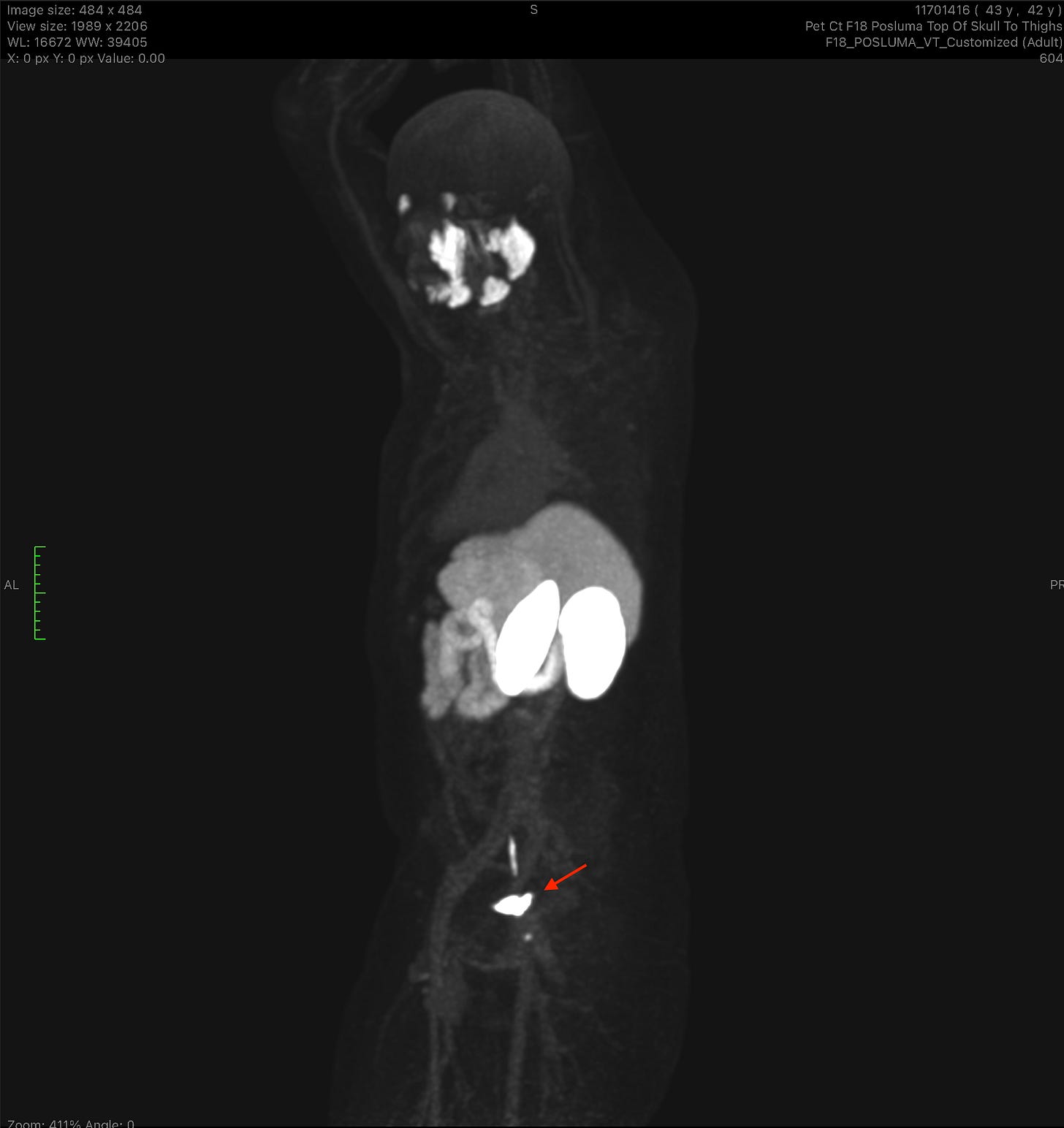 PSMA PET scan: dark silhouette of a body with the tumor lit up bright white.
