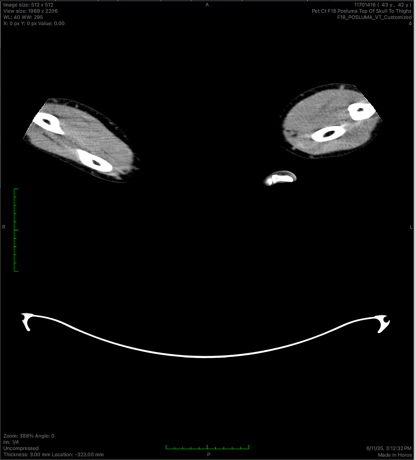 Black-and-white medical scan image, captioned in the post as an unrelated image from my scan.